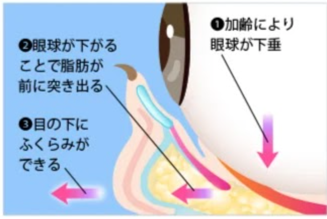 クマができる原因について