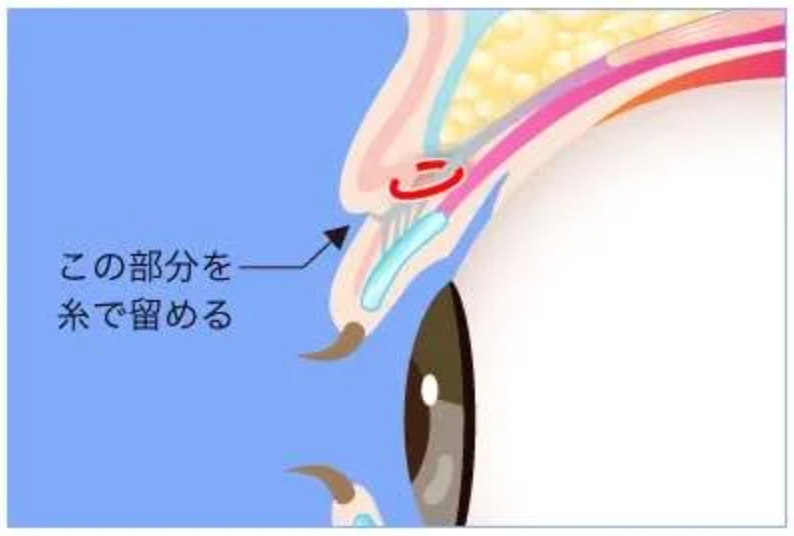 TCB二重術の埋没法