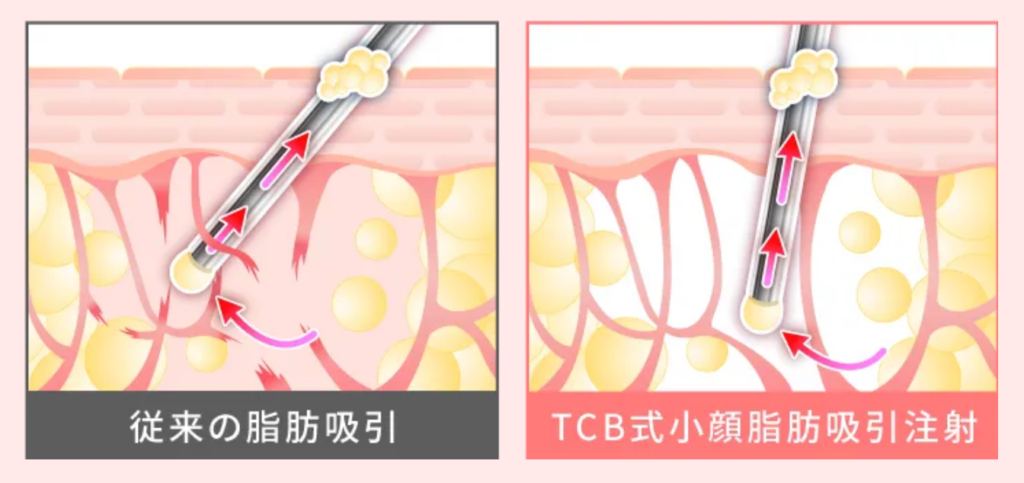 TCB東京中央美容外科の小顔脂肪吸引注射の詳細