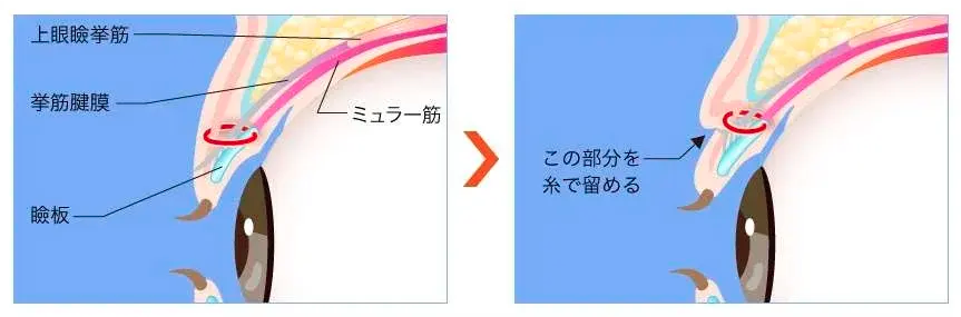 切らない二重整形、埋没法の解説イラスト